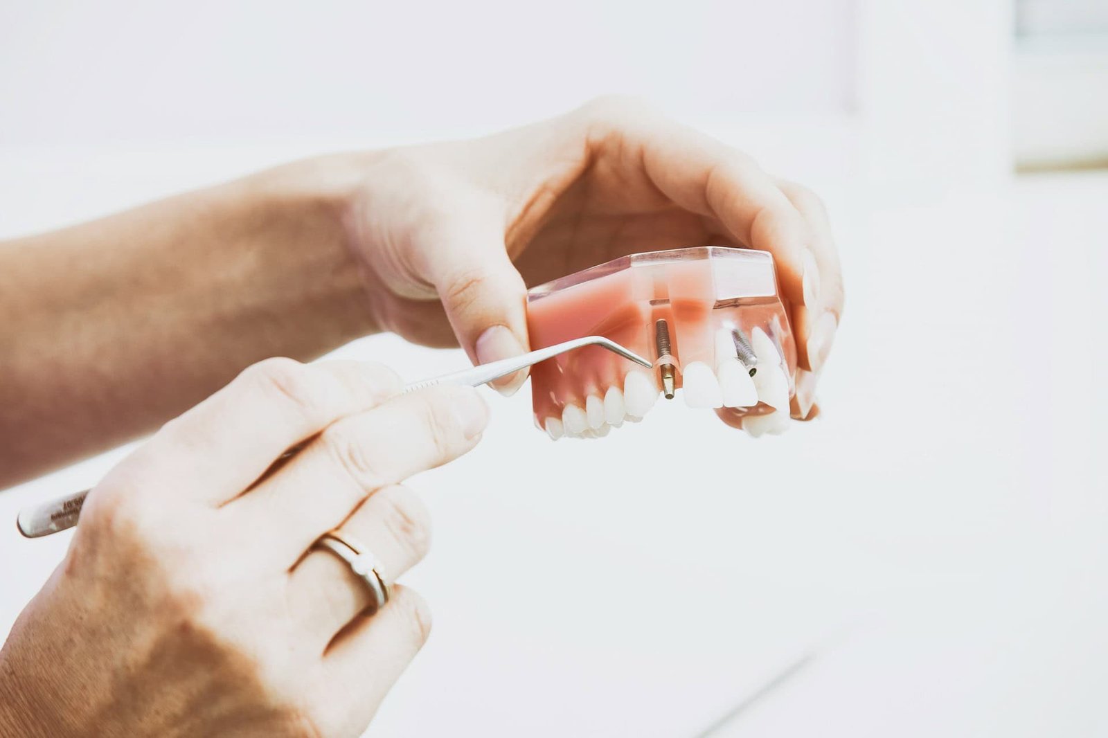 dental implants model